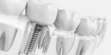Implantate kurz erklärt